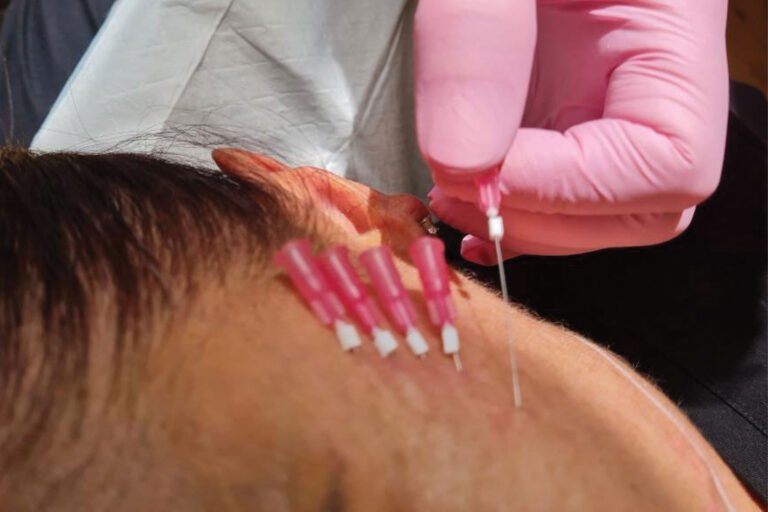 MINT PDO Mono Threads Cosmetic Clinic Newcastle Hunter Cosmetic & Laser