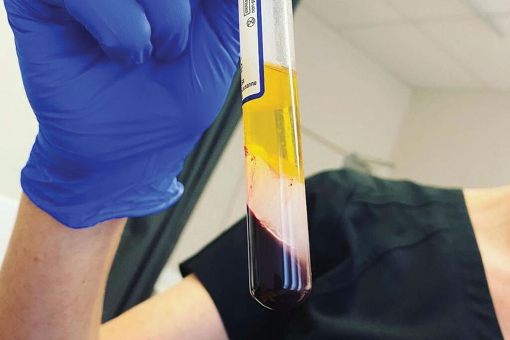 Platelet Rich Plasma (PRP) | Cosmetic Injections Newcastle | Hunter  Cosmetic & Laser